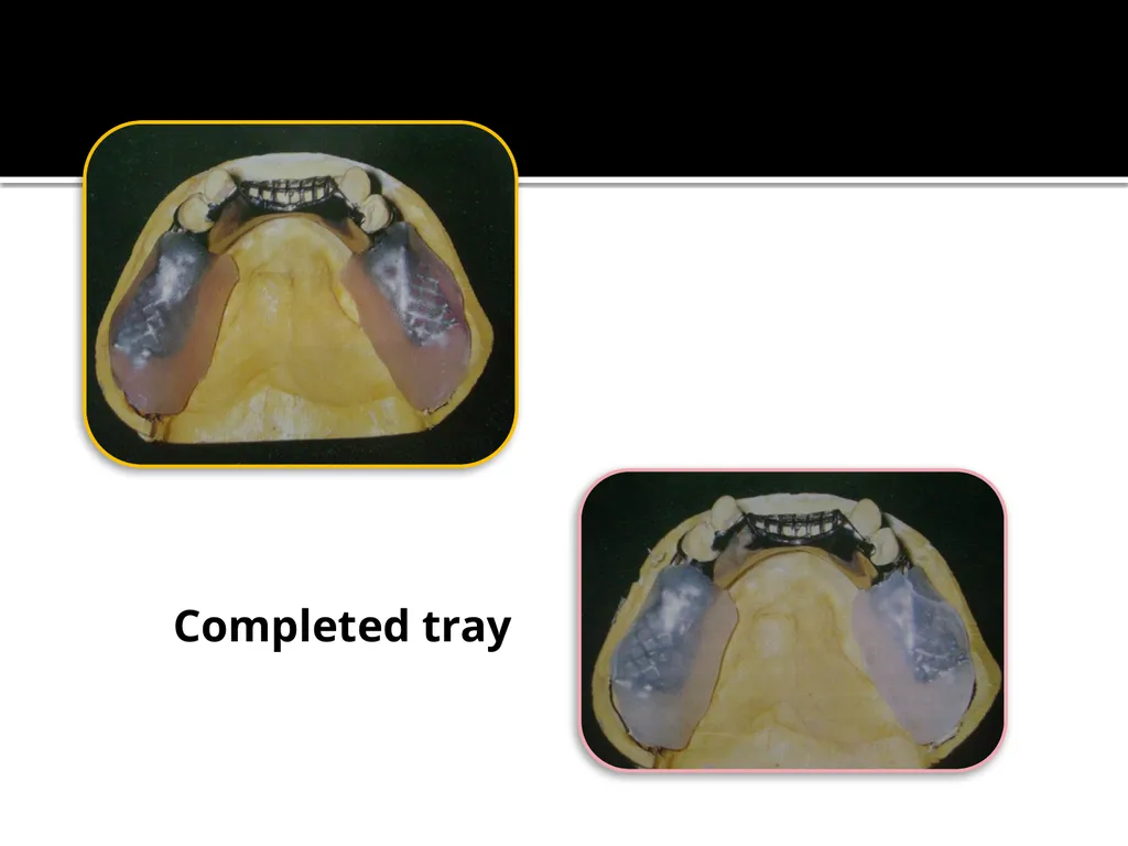 IMPRESSION PROCEDURES FOR REMOVABLE PARTIAL - slide 21 of 30