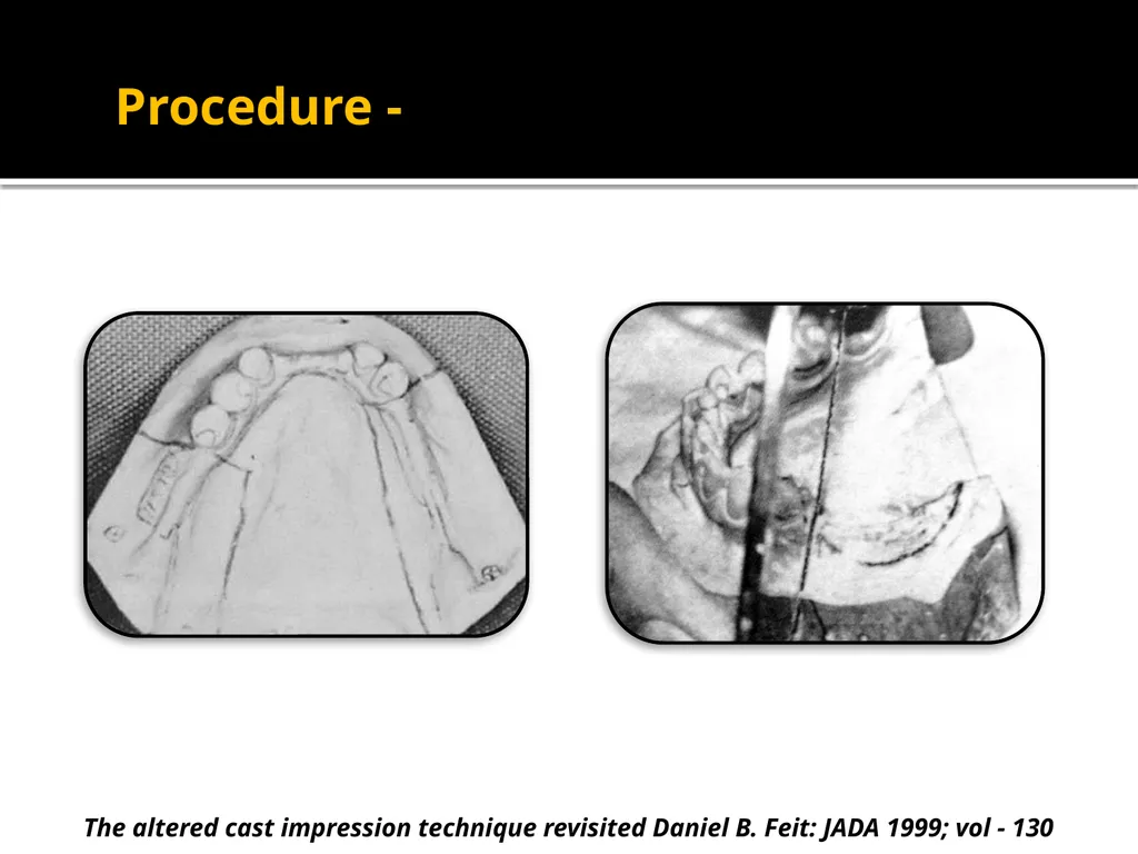 IMPRESSION PROCEDURES FOR REMOVABLE PARTIAL - slide 24 of 30