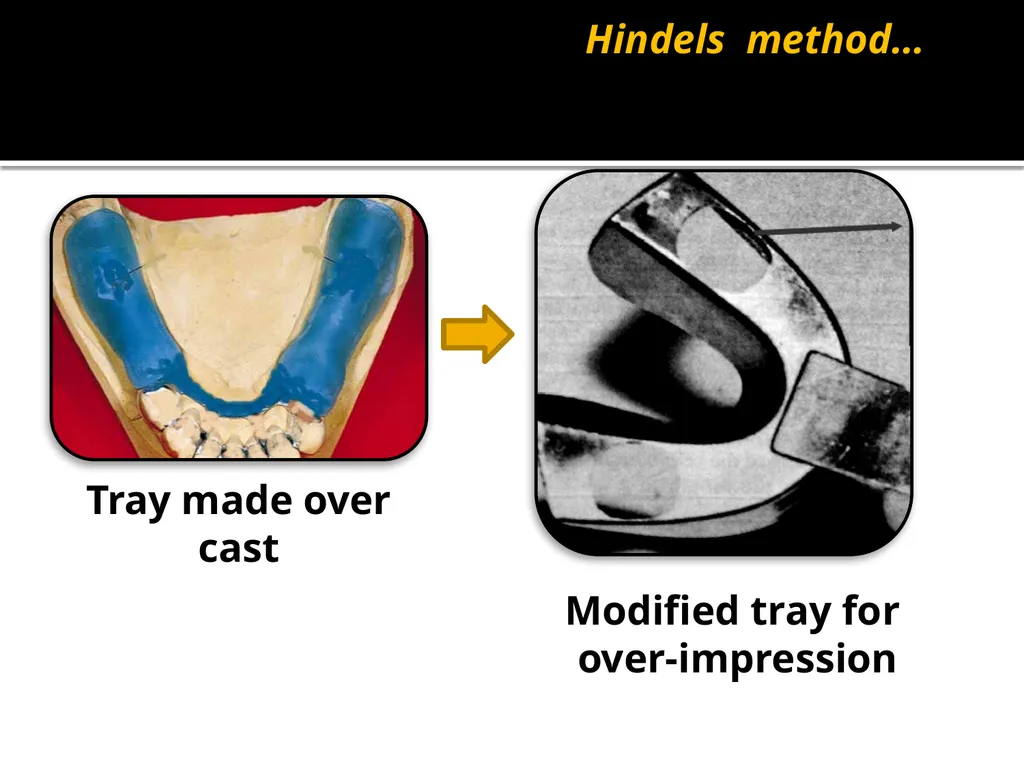 IMPRESSION PROCEDURES FOR REMOVABLE PARTIAL - slide 11 of 30