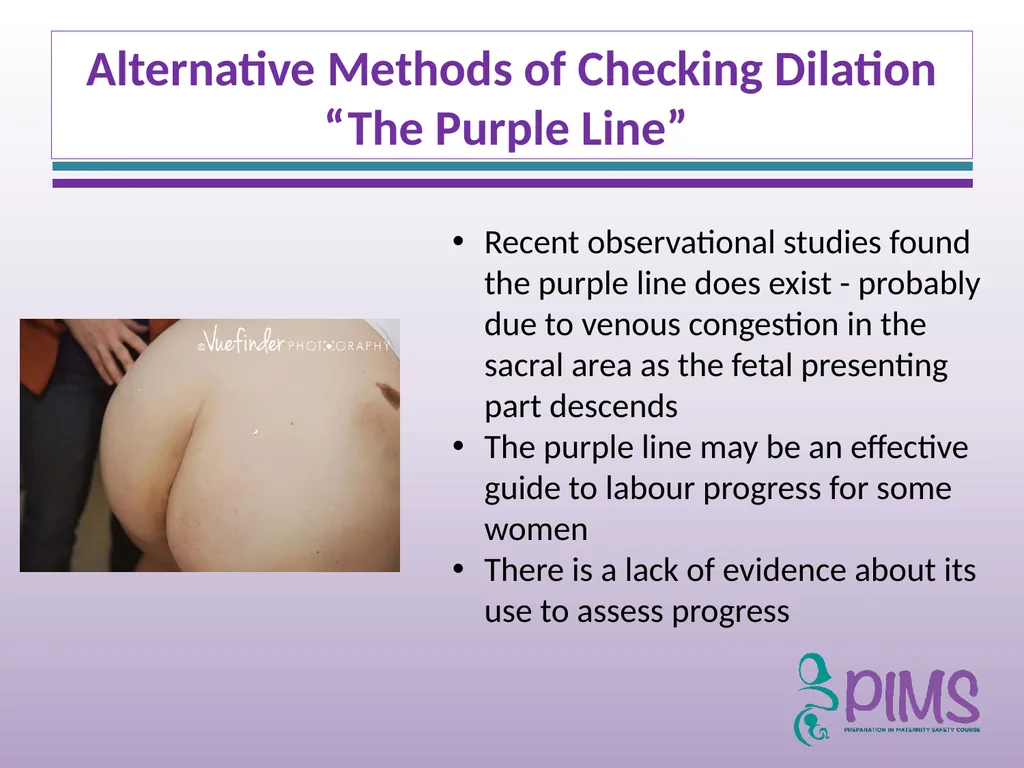 Normal Labour and Birth Objectives Define normal - slide 27 of 35