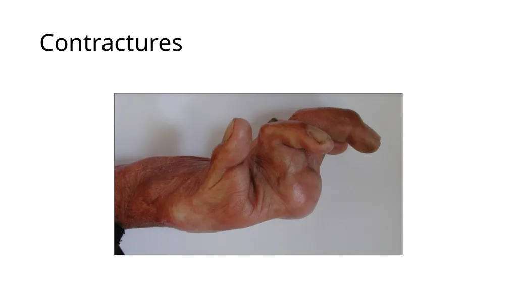 Burns in the Hand Nick Sheppard AO AF / BSSH - slide 13 of 25