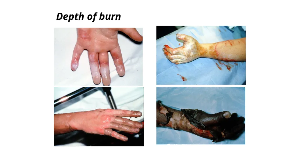 Burns in the Hand Nick Sheppard AO AF / BSSH - slide 3 of 25