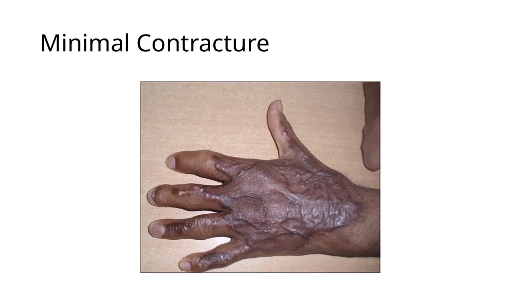 Burns in the Hand Nick Sheppard AO AF / BSSH - slide 12 of 25