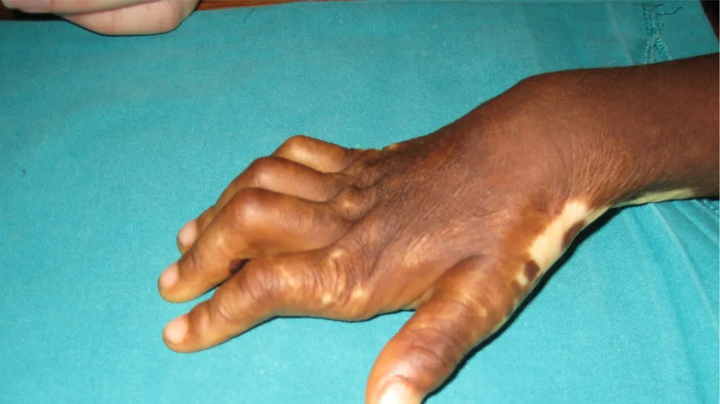 Burns in the Hand Nick Sheppard AO AF / BSSH - slide 15 of 25