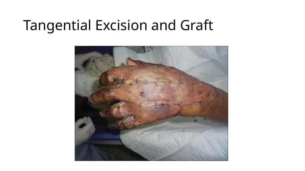 Burns in the Hand Nick Sheppard AO AF / BSSH - slide 11 of 25