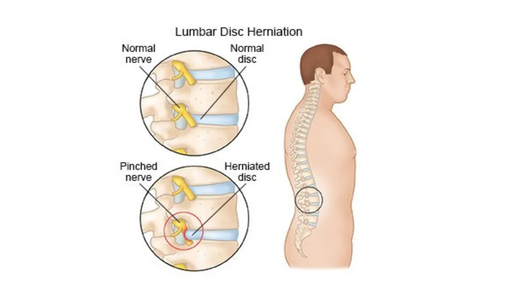 Common Back Pain Issues Presented by Brian Walker, - slide 36 of 47