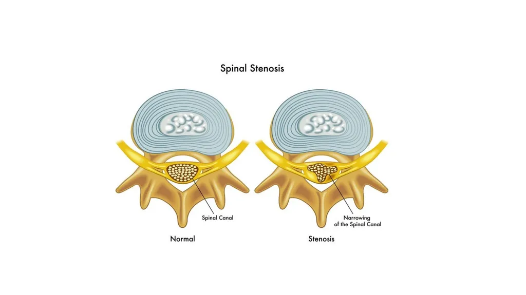 Common Back Pain Issues Presented by Brian Walker, - slide 42 of 47