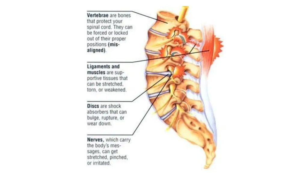 Common Back Pain Issues Presented by Brian Walker, - slide 6 of 47