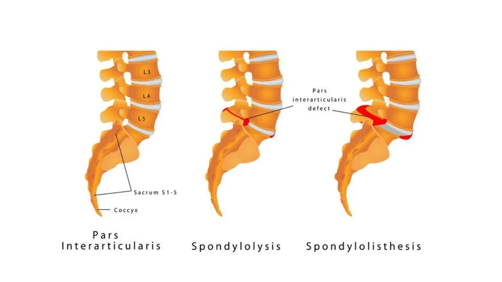 Common Back Pain Issues Presented by Brian Walker, - slide 7 of 47