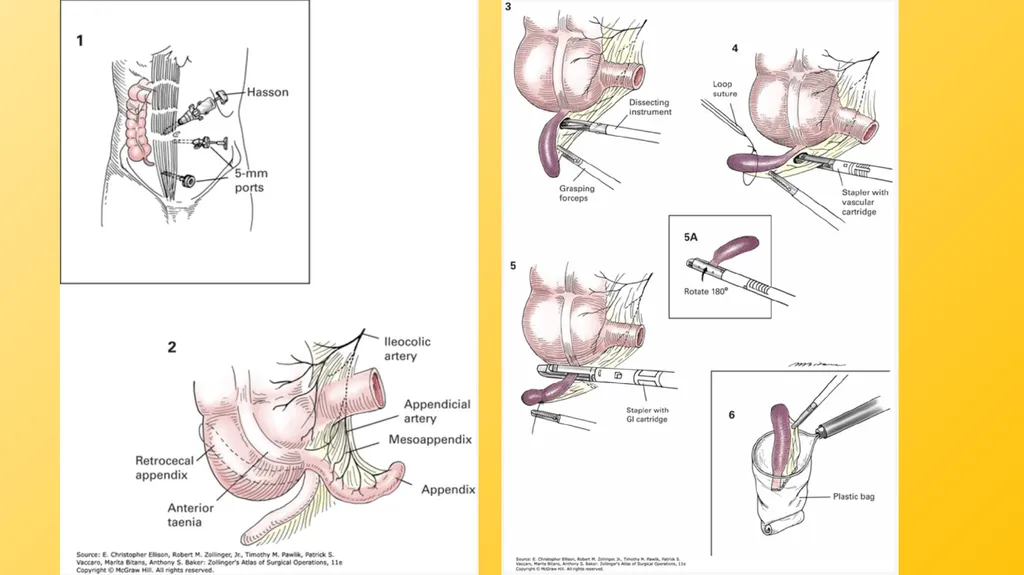 Acute Appendicitis Tyler Klee University of - slide 27 of 30