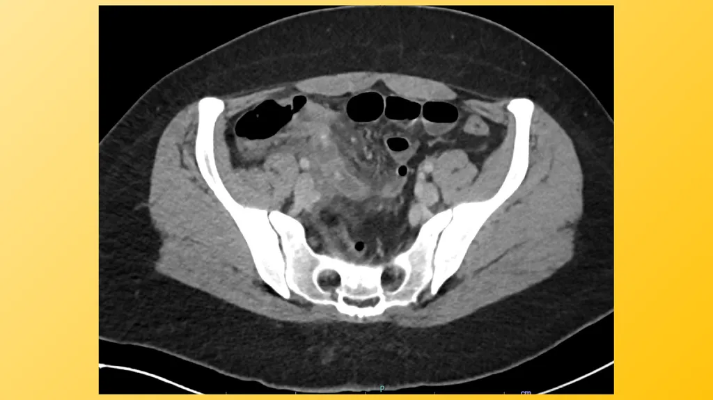 Acute Appendicitis Tyler Klee University of - slide 6 of 30
