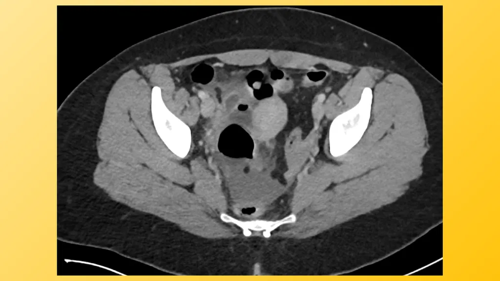 Acute Appendicitis Tyler Klee University of - slide 7 of 30