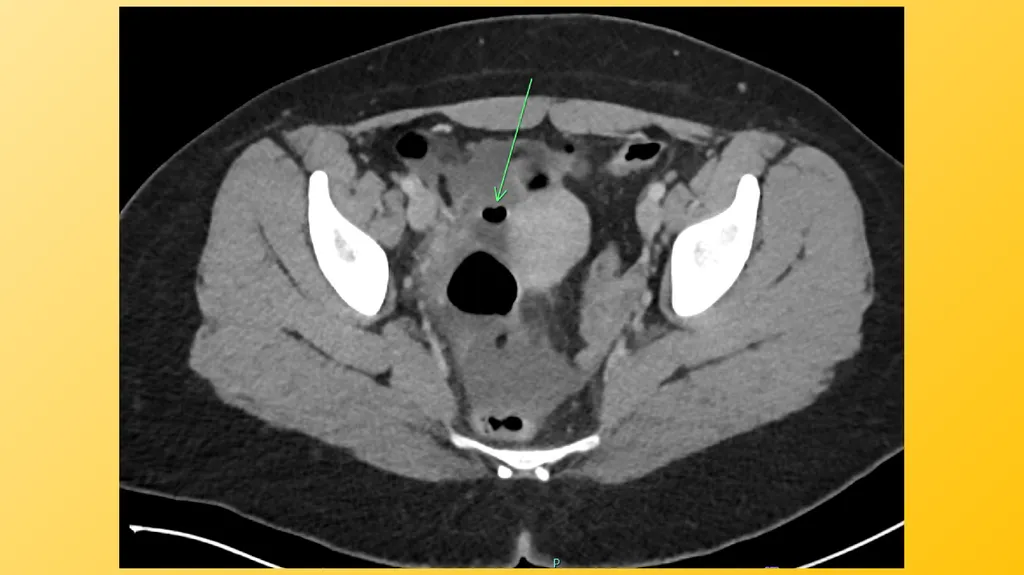 Acute Appendicitis Tyler Klee University of - slide 8 of 30