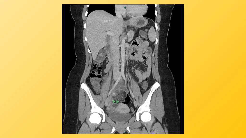 Acute Appendicitis Tyler Klee University of - slide 9 of 30