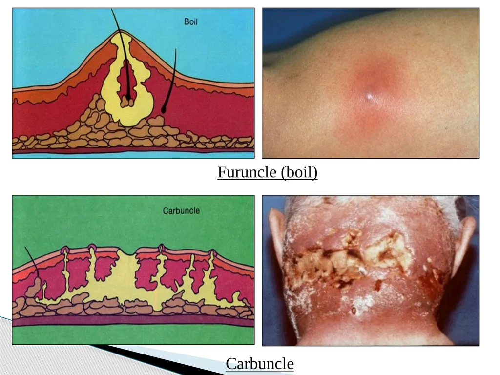 STAPHYLOCOCCUS Staphylococci are : -Gram positive - slide 20 of 42