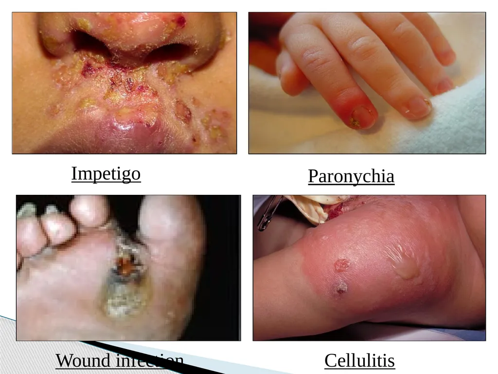 STAPHYLOCOCCUS Staphylococci are : -Gram positive - slide 22 of 42
