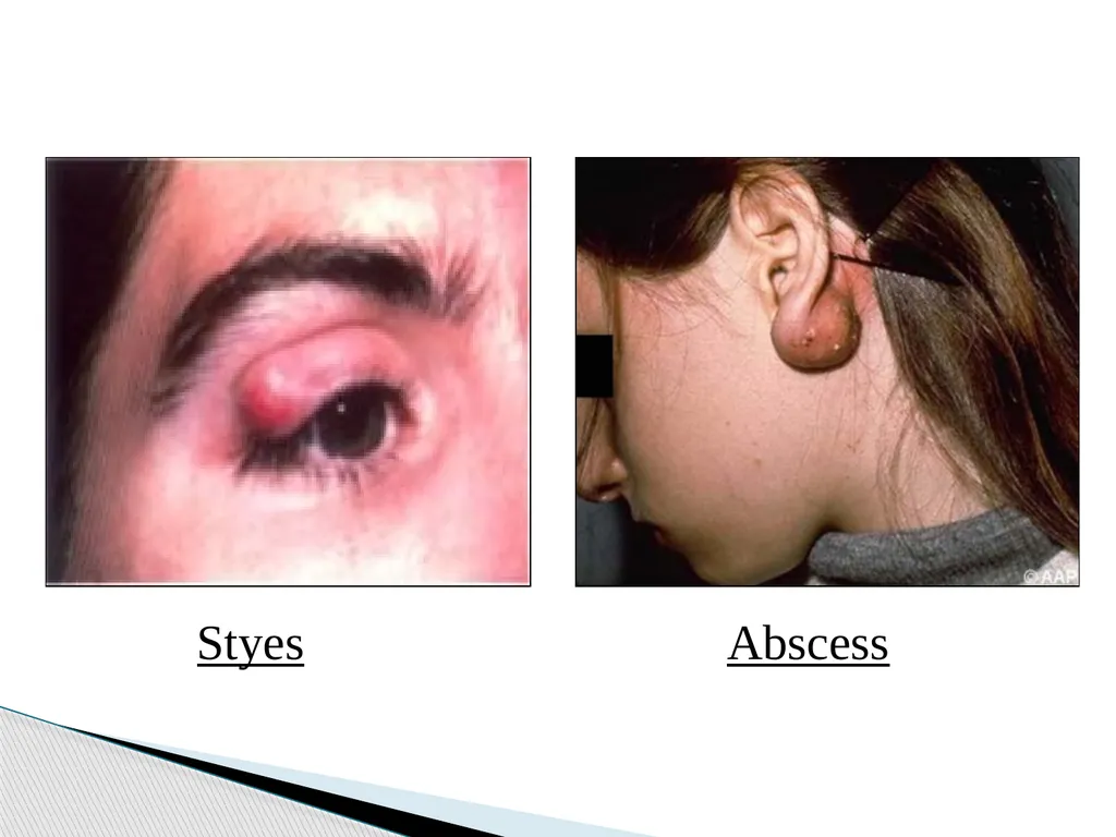 STAPHYLOCOCCUS Staphylococci are : -Gram positive - slide 21 of 42
